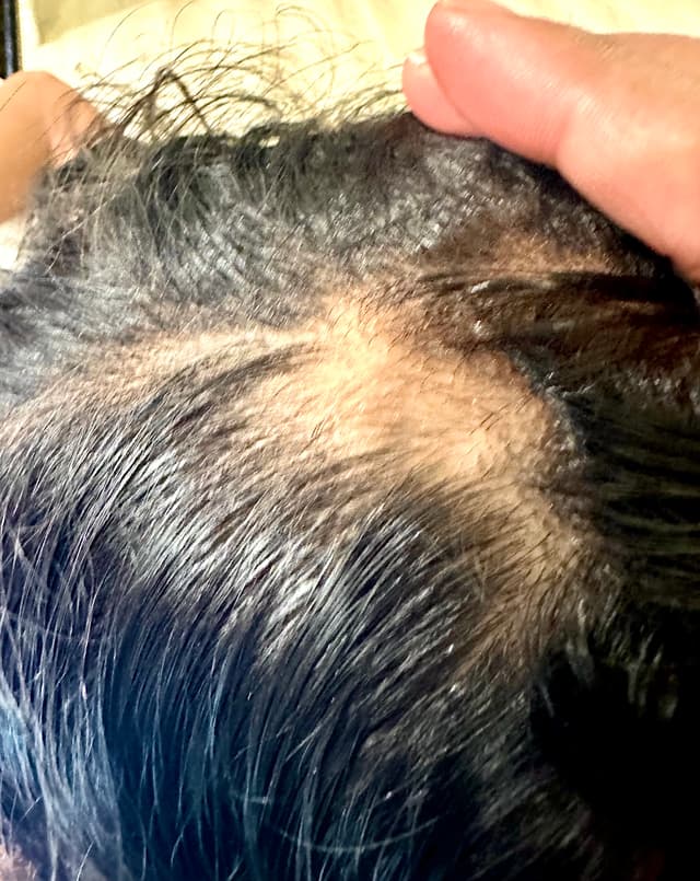 Before - Hair Growth Results