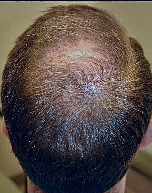 Before - Hair Growth Results